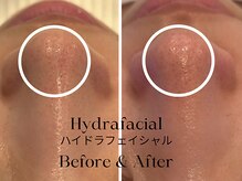 トウキョウビューティーラボ(TOKYO BEAUTY LABO.)/ハイドラBefore&After