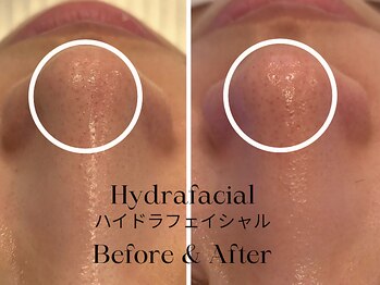 トウキョウビューティーラボ(TOKYO BEAUTY LABO.)/ハイドラBefore&After