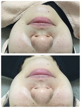 メイユール(MEILLEUR)/光フェイシャル1回