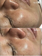 スパークル/毛穴/毛穴毛穴洗浄/ニキビケア