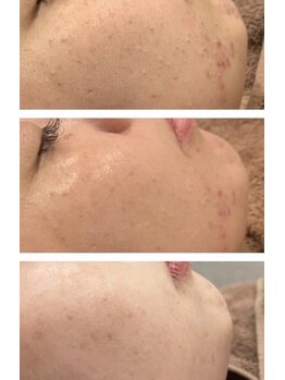 ノノサロン(nono salon)/ニキビケア