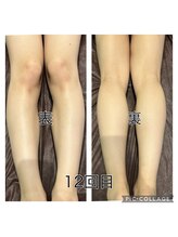 レイモード(Ray mode)/全身脱毛脱毛♪VIOありコース