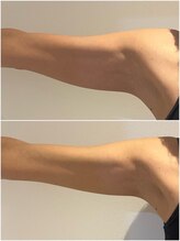 リボディ プラチナ(Rebody platinum)/リフェイス/コラーゲンリフト