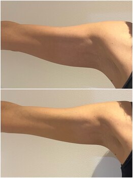 リボディ プラチナ(Rebody platinum)/リフェイス/コラーゲンリフト