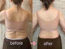 ワンバイゼロ(One by zero)/ボンボンバスト施術後(背面）