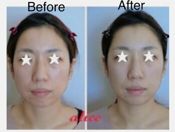 アリス(alice)/20代お客様ビフォーアフター