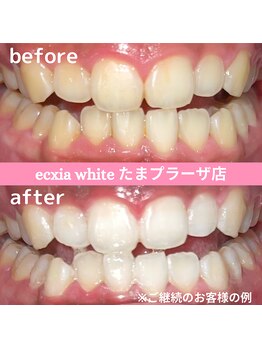エクシアホワイトニング たまプラーザ店/ビフォーアフター