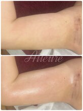 エルール トータルビューティ(Aileure total beauty)/術後DTケア　二の腕　１回施術