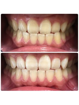 グリッター ショウナン(glitter. SHONAN)/藤沢ホワイトニングbefore/after