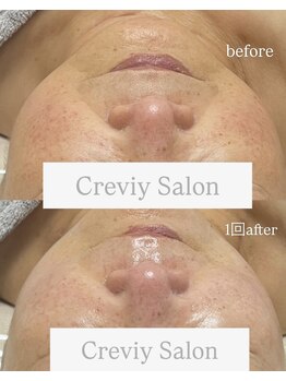 クレヴィー(Creviy)/最先端の細胞美容