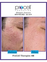 ザ ベッピン(the 別嬪)/4回で肌が滑らかに