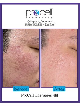 ザ ベッピン(the 別嬪)/4回で肌が滑らかに