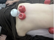 リデザイン 京都(REDESIGN)/中医カッピング療法