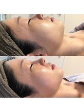 カロン(Kalon)/バザルトでフェイスライン↑