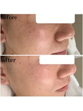 プラセル(Placer)/気になる頬の開きも！？