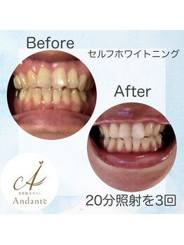 アンダンテ(Andante)/ホワイトニングBefore After