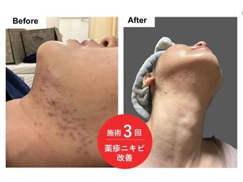 エン(O'en)/エクソソーム＋幹細胞導入！