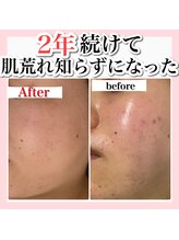 アルムダアクア 天王寺店(Aleumda AQUA)/ハーブピーリング/大阪/天王寺