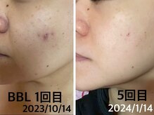 ラブ美長寿 沖縄本店(Lab)/ビフォーアフター光フェイシャル