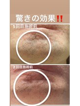 リンカ(Rinca)/髭脱毛！大大大人気！！