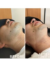 リズム(LISM)/ひげ2回照射後