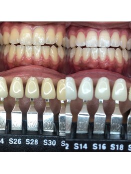 トウキョースワーズ 渋谷店(TOKYO SWRS)/#ホワイトニング #渋谷 #池袋