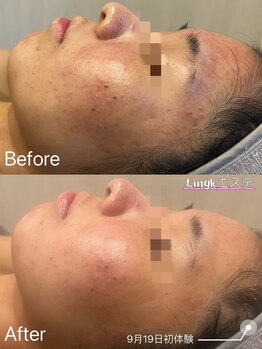 リングケー(Ling K)/大人気!毛穴洗浄ハイドラエステ