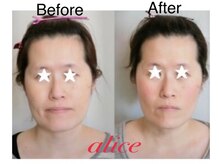 アリス(alice)/30代お客様ビフォーアフター