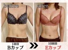 プリマ(prima)/バストアップ症例