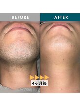 モモナ(Momona)/佐世保/脱毛/髭脱毛/全身脱毛