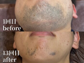 ボス 名古屋店(BOSS)/【ヒゲ脱毛　before & after】