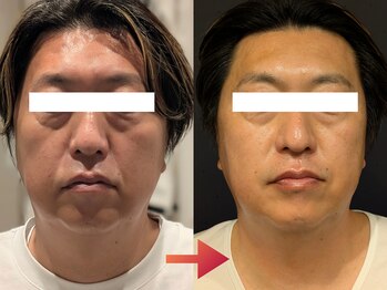 トリニティスペース(TrinitySpace)/レモンボトルビフォーアフター