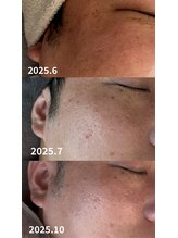 ニコ(nico)/男の肌も、こんなに変われる。