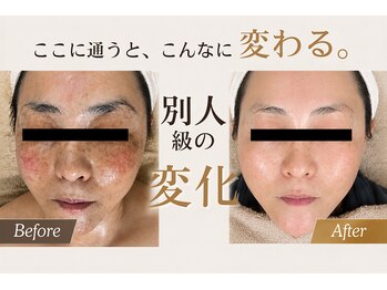 スリミア(Slimia)の写真/【毛穴・シミ・たるみ改善】肌質改善ピーリングで透明感あふれる美肌へ♪