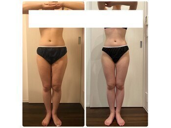 リボディ プラチナ(Rebody platinum)/キャビテーション/ラジオ波/吸引