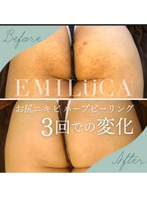 エミルカ 岡山店(EMILUCA)/お尻の施術事例　三回目ご来店時