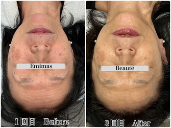 エミマス ボーテ(Emimas Beaute’)/６０代毛穴洗浄＆幹細胞３回目