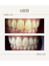 ホワイトニングショップ 福岡姪浜店/美白ホワイトニングbefore after