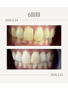 ホワイトニングショップ 福岡姪浜店/美白ホワイトニングbefore after