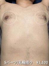 カナウ(KANAU)/【Sパーツ/脱毛】乳輪周り
