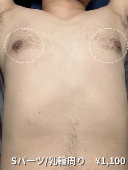 カナウ(KANAU)/【Sパーツ/脱毛】乳輪周り