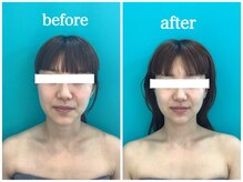 メディカルサロンドオフ 堺東店(medical salon de off)/光造顔フェイシャル★ 施術前後