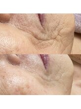 メアリス(Mearis)/一回でこの効果