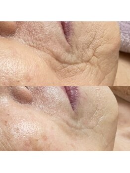 メアリス(Mearis)/一回でこの効果