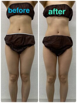 ハロ 南青山(HALO)/全身キャビラジ+太もも脂肪取り