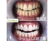 ルブラン 奈良店(Le Blanc)/キレイな歯に！