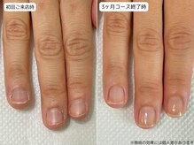 カピリナ(Ka Pilina)/自爪育成・川崎・深爪