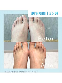 メンズクリア ららぽーと和泉店/【メンズクリア】お客様の施術例