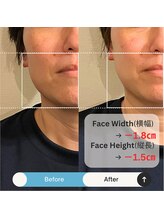 ブルハ(Bruja)/小顔矯正『コルギ』A1