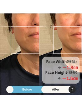 ブルハ(Bruja)/小顔矯正『コルギ』A1
